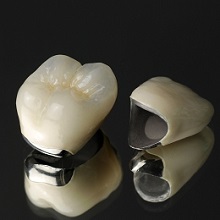 ｾﾗﾐｯｸについて] 鹿児島市吉野町の歯医者 小田原歯科